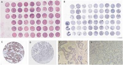 Notch-Jagged1 signaling and response to bevacizumab therapy in advanced colorectal cancer: A glance to radiomics or back to physiopathology?